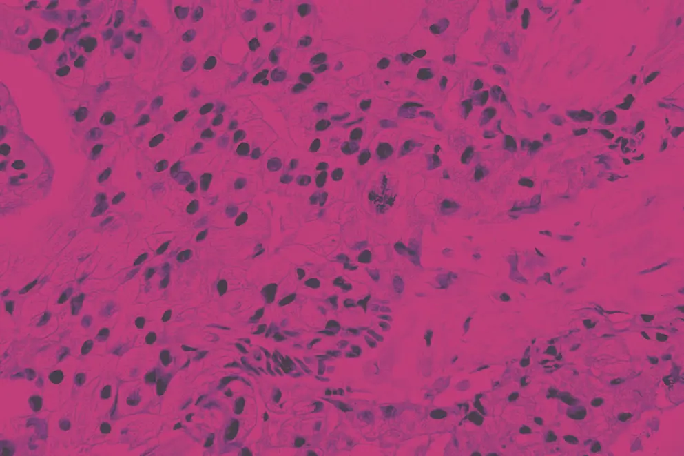 AdobeStock_405844682 Photo of prostate carcinoma with atypical mitosis, photo under microscope, magnification 400x, Pink and purple colours