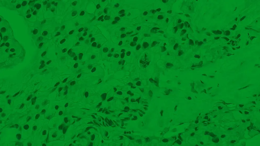 Micrograph of a prostate carcinoma with atypical mitosis rendered in green