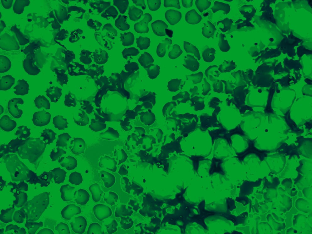 Bone marrow aspirate cytology of multiple myeloma, a type of bone marrow cancer of malignant plasma cells. 