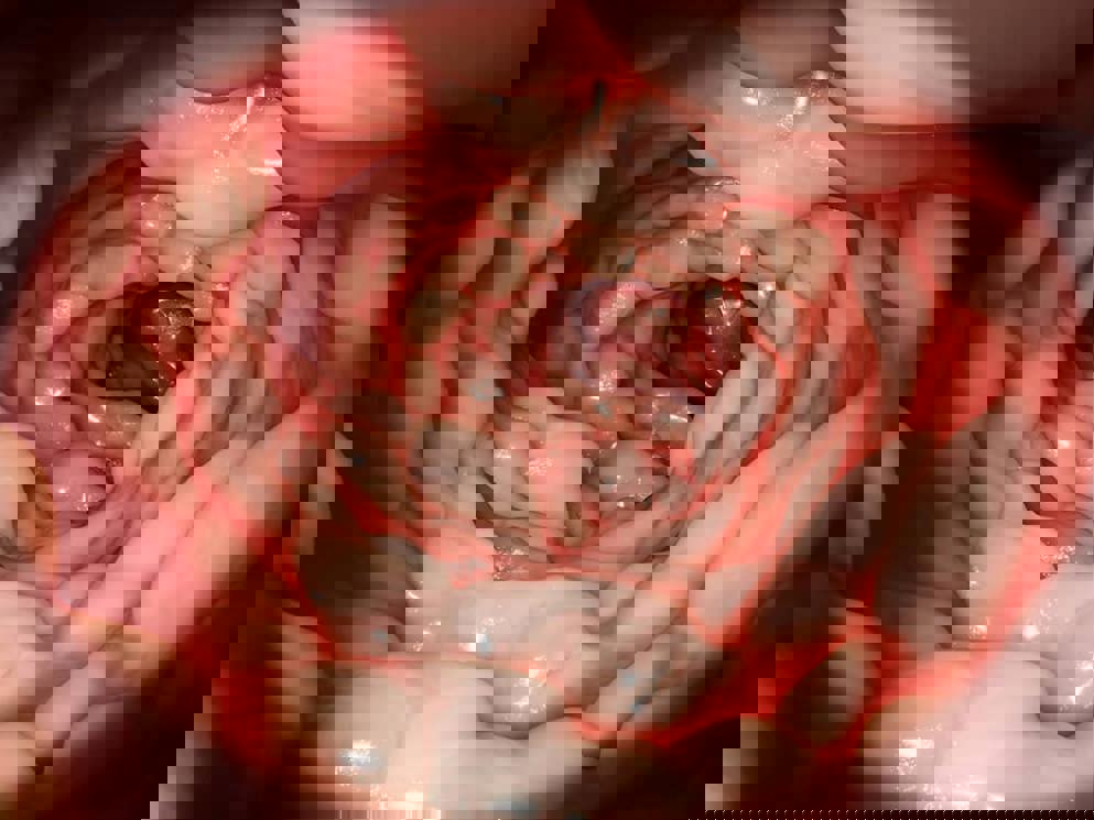 Ulcerative Colitis