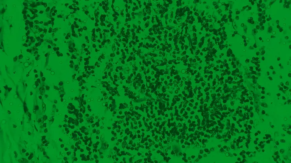 Hidradenitis suppurativa in axillary mass tissues